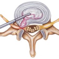 Современный метод избавления от боли: эндоскопическое удаление грыжи позвоночника